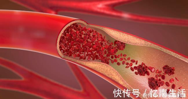 静脉|体内有血栓,脚知道脚上若有4种反应,小心血管随时爆发