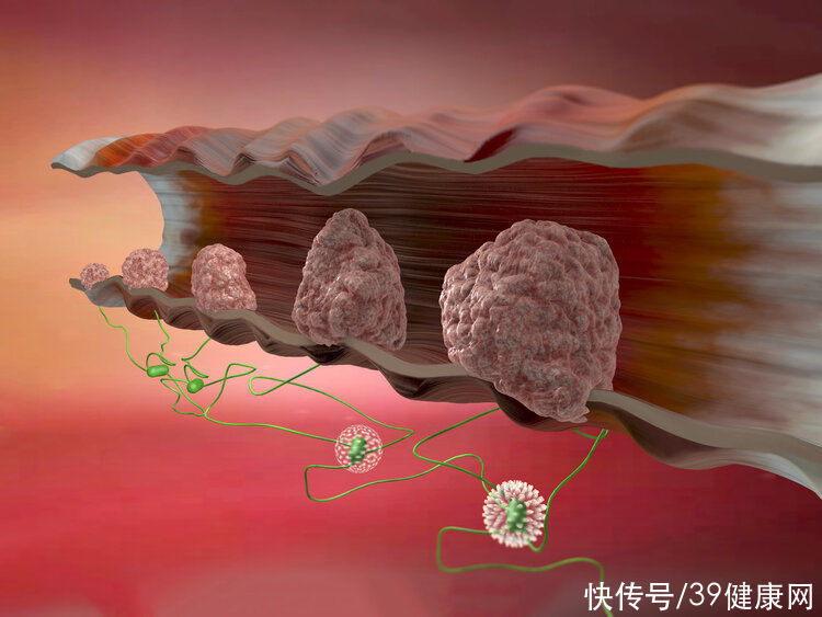 肉疙瘩|肛门长小肉球、肉疙瘩，是怎么了？除了痔疮，还有4个可能性较大