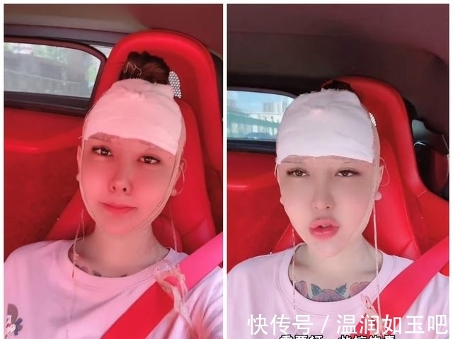桃花|网红整容后不敢出门,玻尿酸融化成“液体”流动,整张脸像热水袋