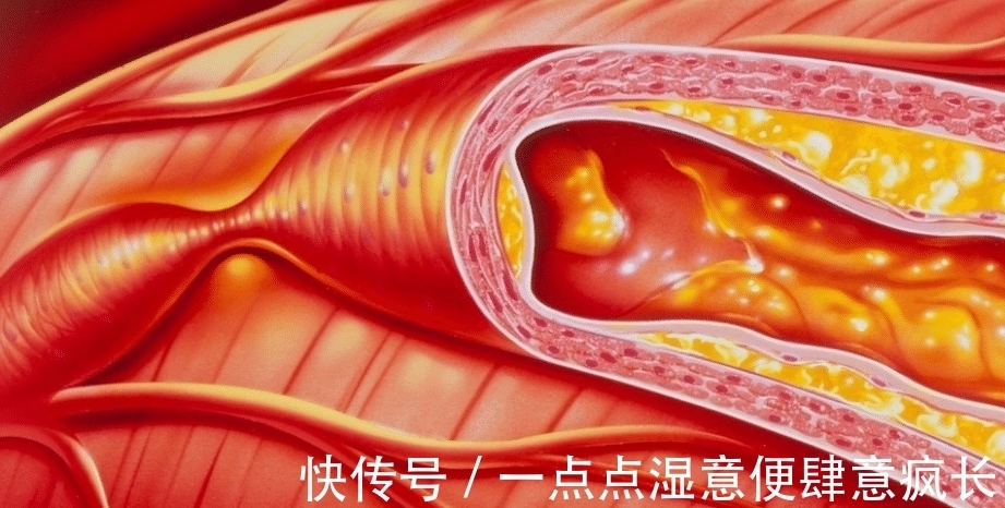 血脂|吃炸花生会升高血脂？医生：无知，不想血脂“飙升”，3种下酒菜要少吃