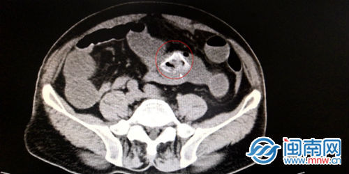 老汉|吃菠萝蜜不吐核 漳州一八旬老汉引发肠梗阻