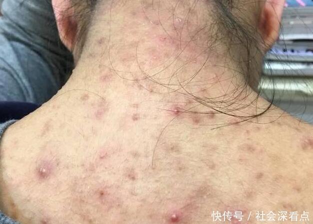 后背经常长黄色“小米粒”一抠一个坑,一个小妙招,荡平后背痘痘