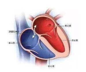 圆孔|反复头晕头痛竟是心脏上的“小洞”在作怪