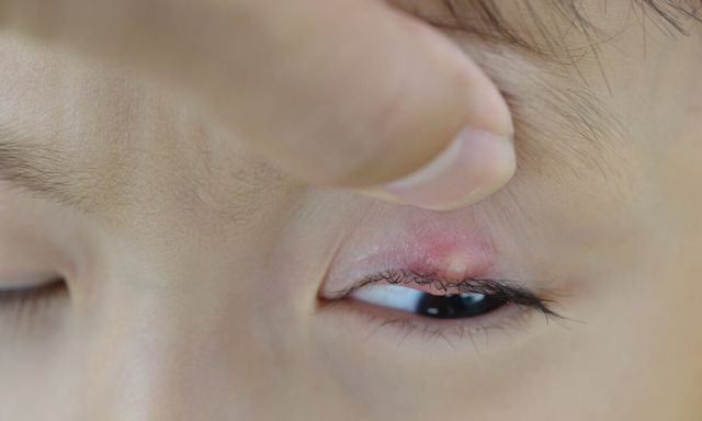 玲玲|孩子长了“针眼”,怎样才能消得快?医生提醒:千万不能用手挤