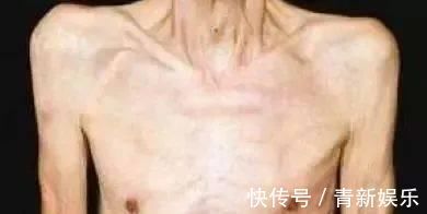肝癌|58歲老漢，感冒總不好，查出肝癌，醫生用一東西養生，大錯特錯