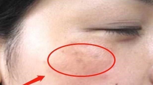 炎症|女性患有妇科炎病脸上多有3大变化，常喝1杯水，抑菌消炎养子宫