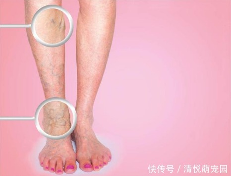心血管医生提醒这些症状是血管堵塞、血栓预兆！这样才能预防