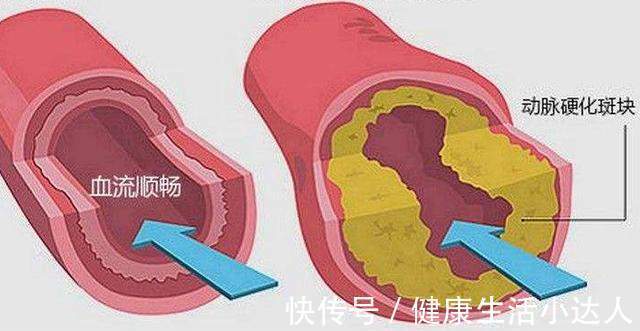慢跑|三种食物吃太多,血脂会超标,身体出现6个表现,抓紧降脂吧