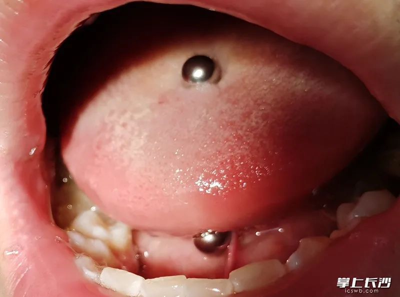 小涵|16岁女孩打赌输后,在舌头上干这事,医生慌了