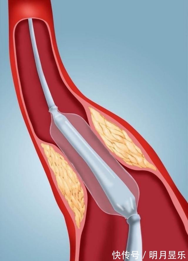 低密度脂蛋白|降血脂、软化血管、清理血管垃圾,不能只依靠药物,更要依靠自己