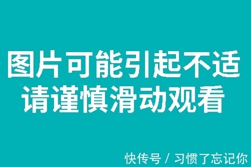 瓜子|头皮发麻！男子体内惊现大量“瓜子”活虫……取出来还在动！