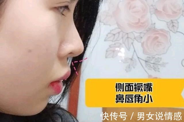 唇部 做什么医美改善凸嘴效果最快!