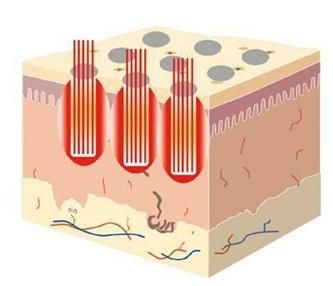 皮肤科普小知识丨去黑头有些什么办法？