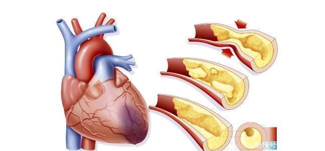 胆固醇|坚持走路运动,真的可以逆转动脉硬化吗