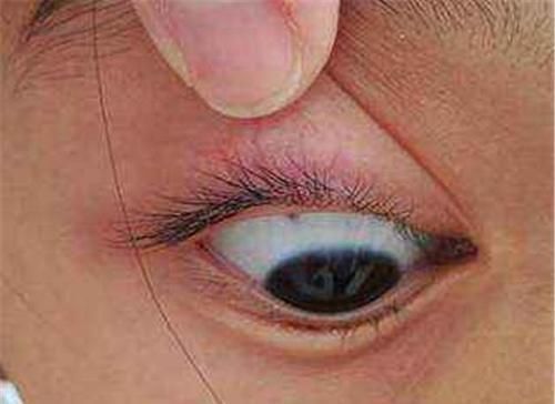 眼白处|3岁女儿眼睛出现“多个黑点”，原因竟是奶奶买的“哄娃神器”