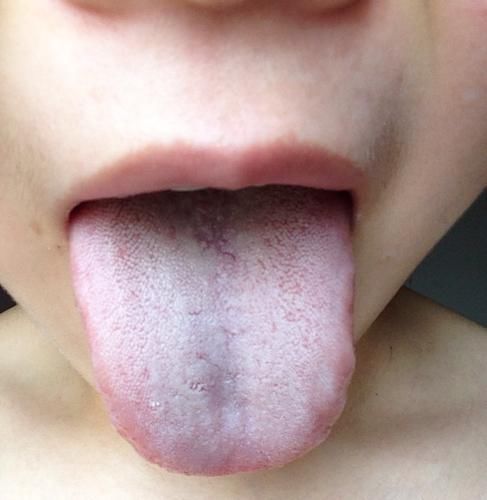 西医|舌头也是“警报器”,教你观察舌头的5种现象,平时要多留心