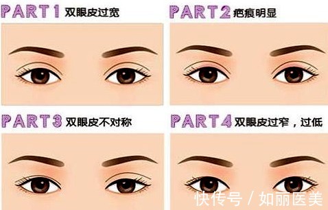 手术 双眼皮修复手术多久可以做?恢复期是多久?