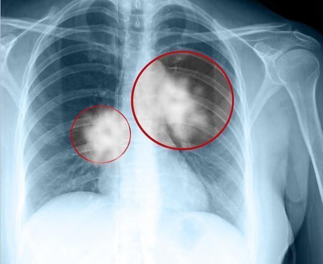 老李|46岁男子，不痛不痒，查出肺癌，手上1个标记，提示已到中晚期