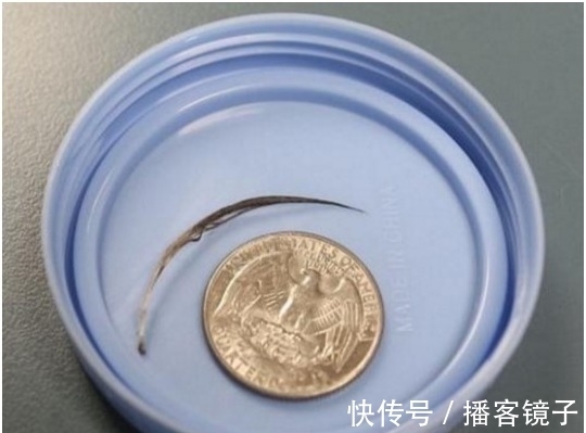 红肿|父母带着脖子突出一根东西的女婴去医院 一往外拉连医生都吓傻