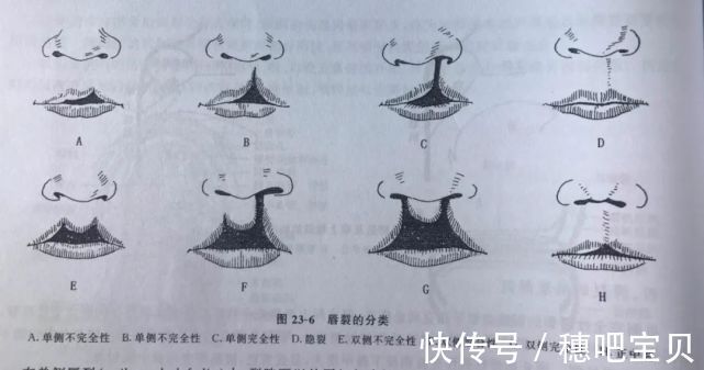 科普|天使科普：唇裂腭裂早知道