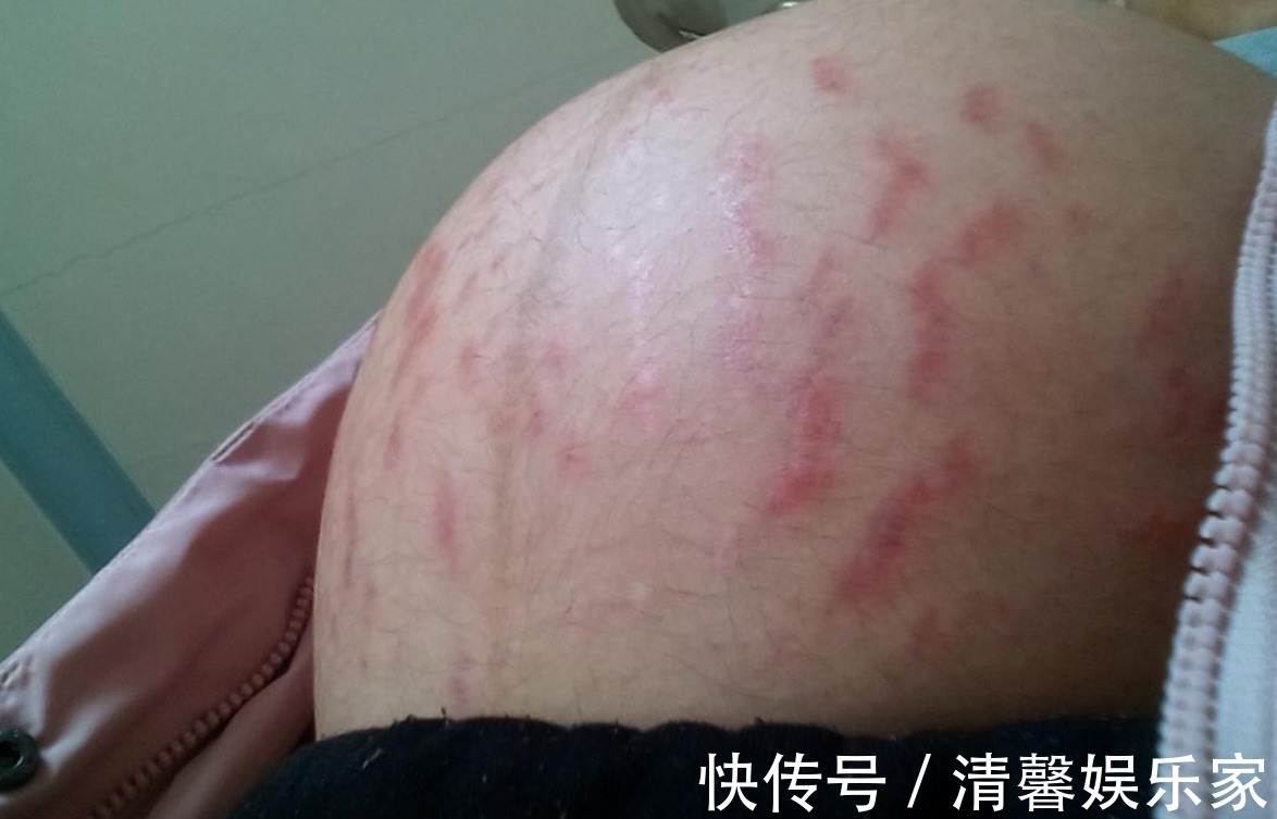 肚皮|孕期妊娠纹“找上门”,体重控好锻炼不能少,坚持守住三原则