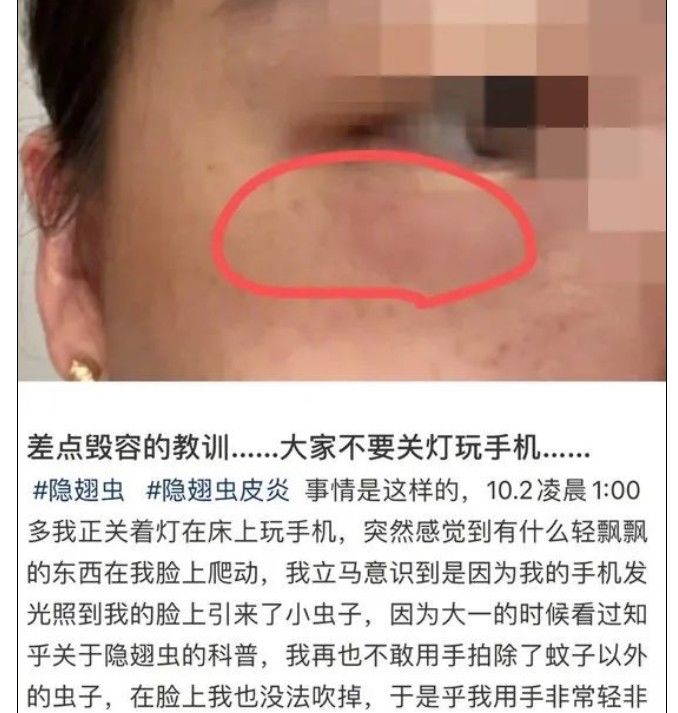 隐翅虫|又是它!女子半夜关灯玩手机,险些致毁容……