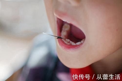 牙齿|孩子乳牙没掉，新牙就已长出？造成孩子乳牙脱落晚的原因不止一种