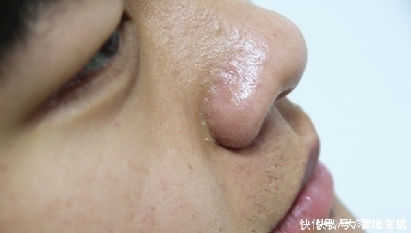 鼻头|鼻子经常出油,多喝水管用吗?哪些方法,能帮你摆脱油鼻头
