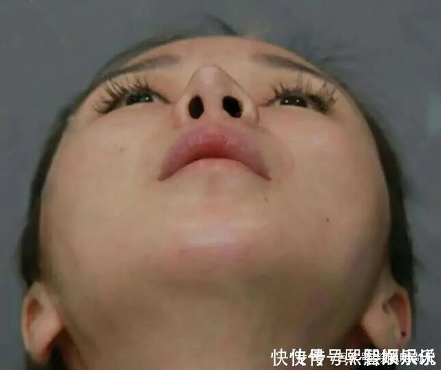 蒜头鼻|五种公认的“丑鼻型”,蒜头鼻、驼峰鼻都上榜了,第一个最常见