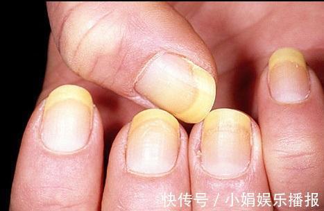 黄甲综合征|身体有问题,指甲告诉你!指甲出现9种变化,恐是疾病来袭
