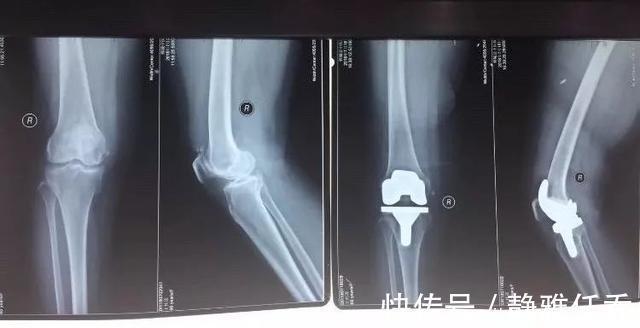 慢跑|夫妻双双膝盖废了，疼痛犹如分娩，只因长期这么做……