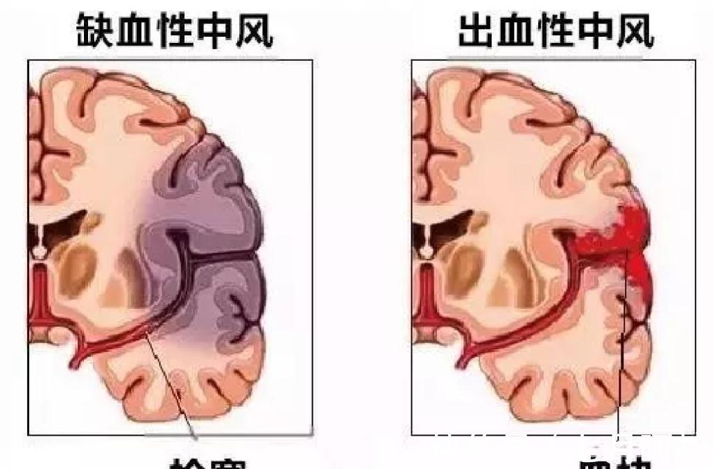中风|高血压是“中风”的祸根,提醒:4个表现,多半中风已找上门