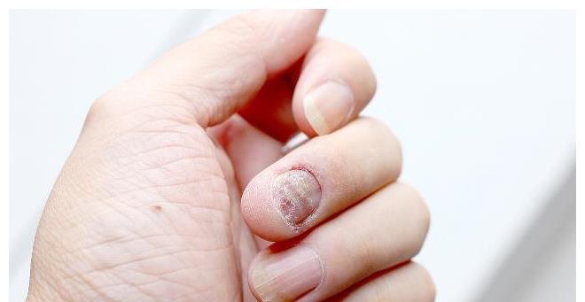 养肝护肝|肝脏好不好,比个中指就知道,若中指没有这些变化,说明肝还不错