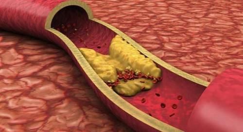 下降|甘油三酯“害怕”一物,不是大蒜,水里撒1把,血脂乖乖下降