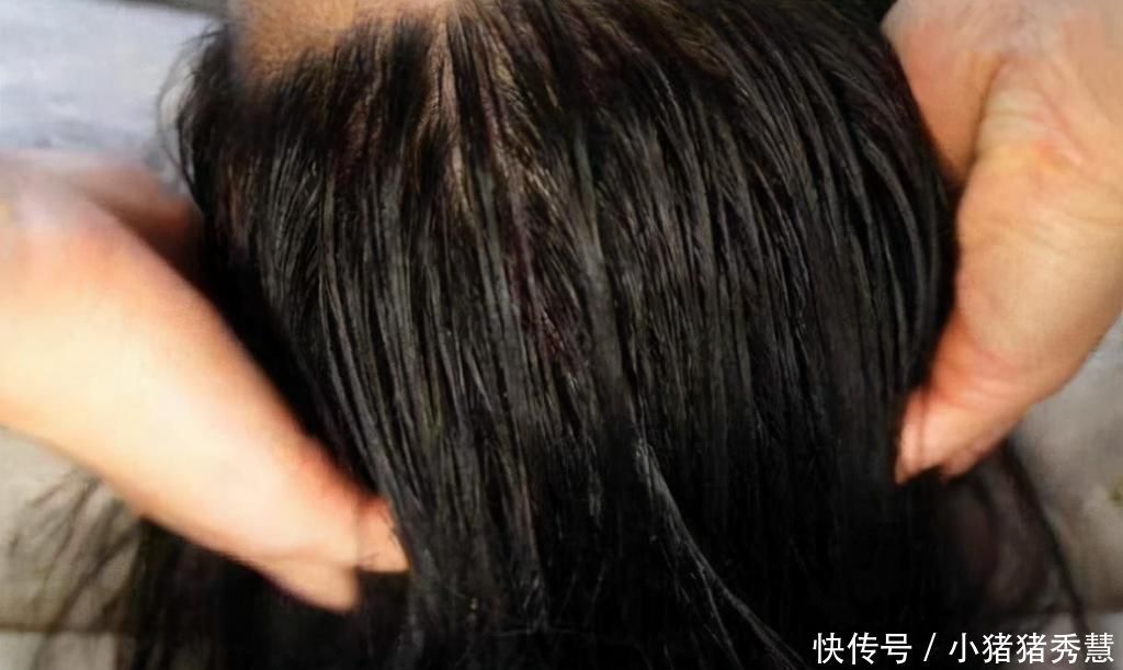 头发|头发油腻，经常抠出“白泥”？别不以为意，其实跟螨虫有大关系
