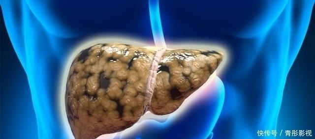 柔软|医师直言：养肝不需太复杂，平时少吃这2样东西，肝会慢慢变柔软