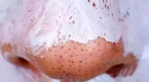 黑头|女生鼻子上“黑头泛滥”,坚持这3个好习惯,鼻子会越来越白净