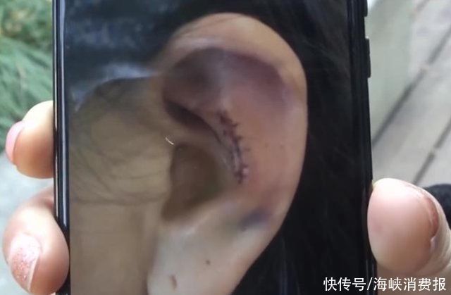 鼻子|女气取耳朵软骨隆鼻,术后耳朵变形维权未果,医院她本就长这样