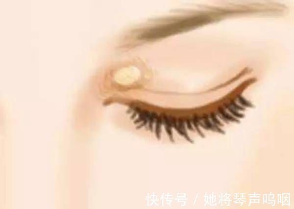 血栓|眼睛有三个信号,是血脂已高,防血栓,做好“戒三物,远四习”!