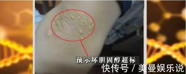 血管|脸上出现这2个变化,要注意了!降血脂、护血管的食物都在这了