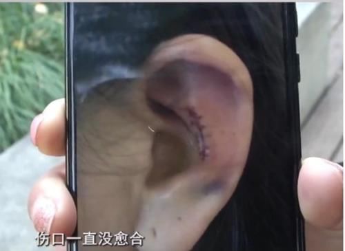 隆鼻手术后耳朵变形，十多万索赔被拒，医院：没有特别失败