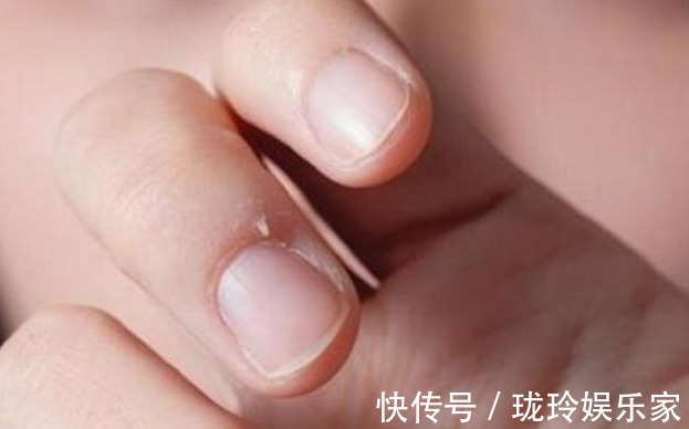 营养物质|孩子手上经常出现“倒刺”，家长着急，可能是3个原因引起的