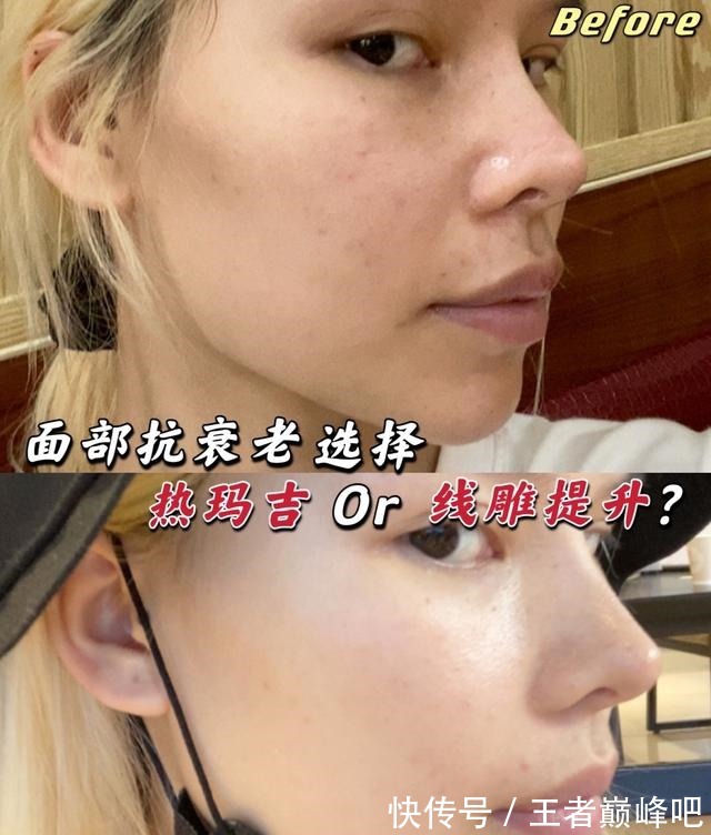 紧致 面部抗衰老,选热玛吉还是线雕提升!