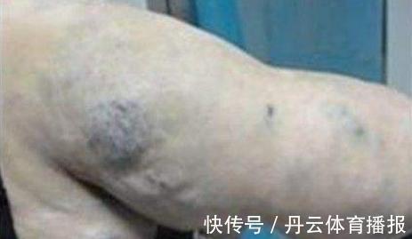 祸根|胎记长在哪里最有福气?恕我直言,2种胎记长哪都可能是祸根