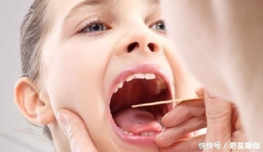 当舌苔出现这5种情况时,暗示你将“疾病缠身”,需警惕!