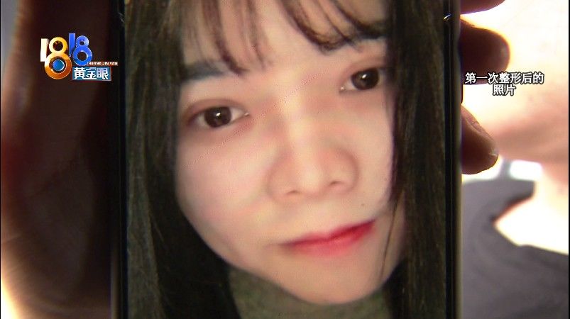 “壹加壹”修复鼻子，“朝天鼻”没有改善？