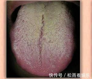 小便方|一张治口腔溃疡的小便方!两味药,解开人间难题