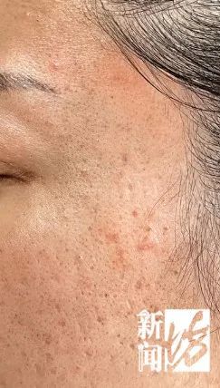 干细胞|别拿脸开玩笑!沪上一女子在美容院“做脸”,却越做越没脸见人…