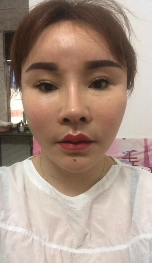 不到50岁就老成大妈？小拉皮术后6个月轻松实现逆生长！