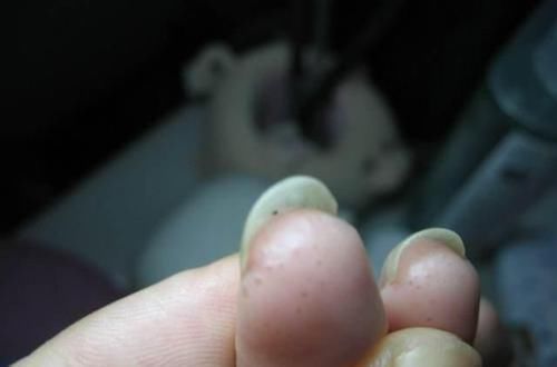 汗疱疹|手上长透明小水泡,还反复发作?其实不是上火,少做3件事摆脱它